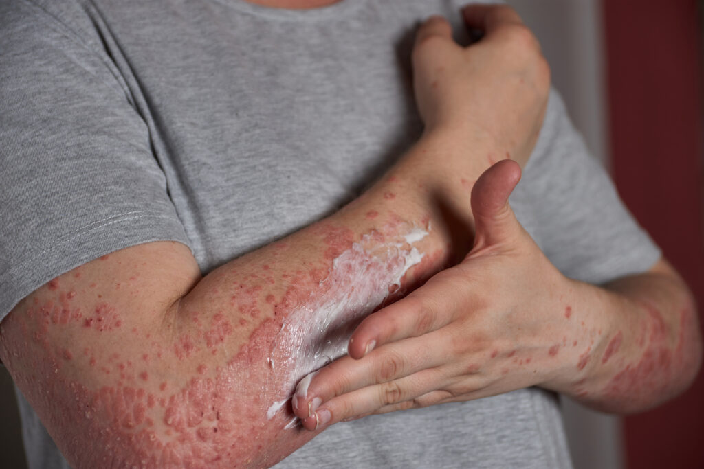 Shingles Vaccination: Who Should Get It and Why?