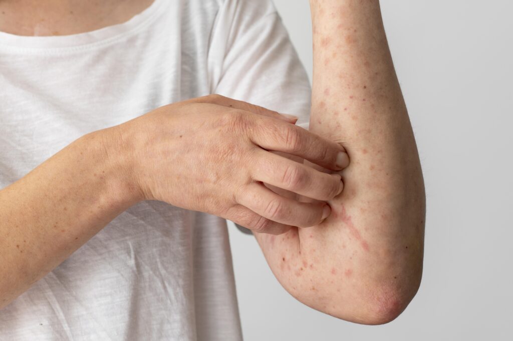 Chickenpox Vaccine for Adults: Is it Available at Your Pharmacy?